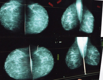 乳腺癌X线