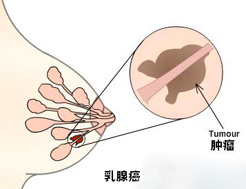 乳腺癌图谱