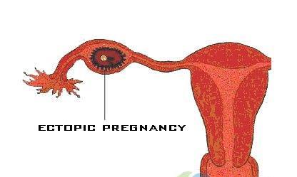 宫外孕的图片