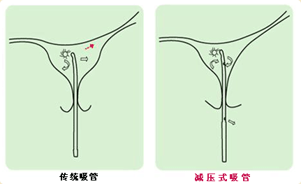 传统吸管与减压式吸管对比