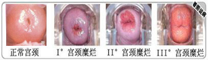 宫颈糜烂