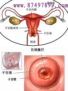 宫颈糜烂