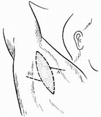 腋臭手术图