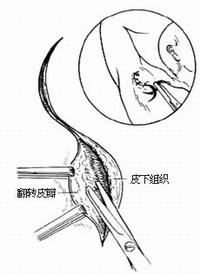 腋臭手术