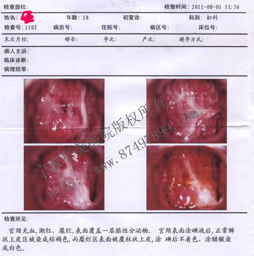 华美医院数码阴道镜检查