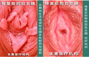 处女膜修补