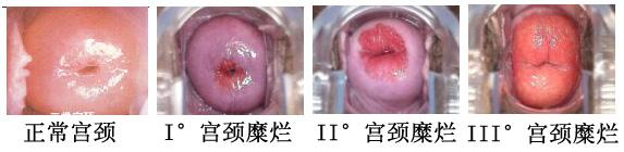 宫颈糜烂的图片