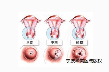 宫颈糜烂到宫颈癌的症状