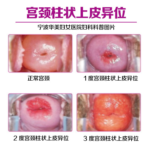 柱状上皮异位