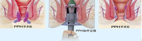 PPH如何治疗痔疮发作